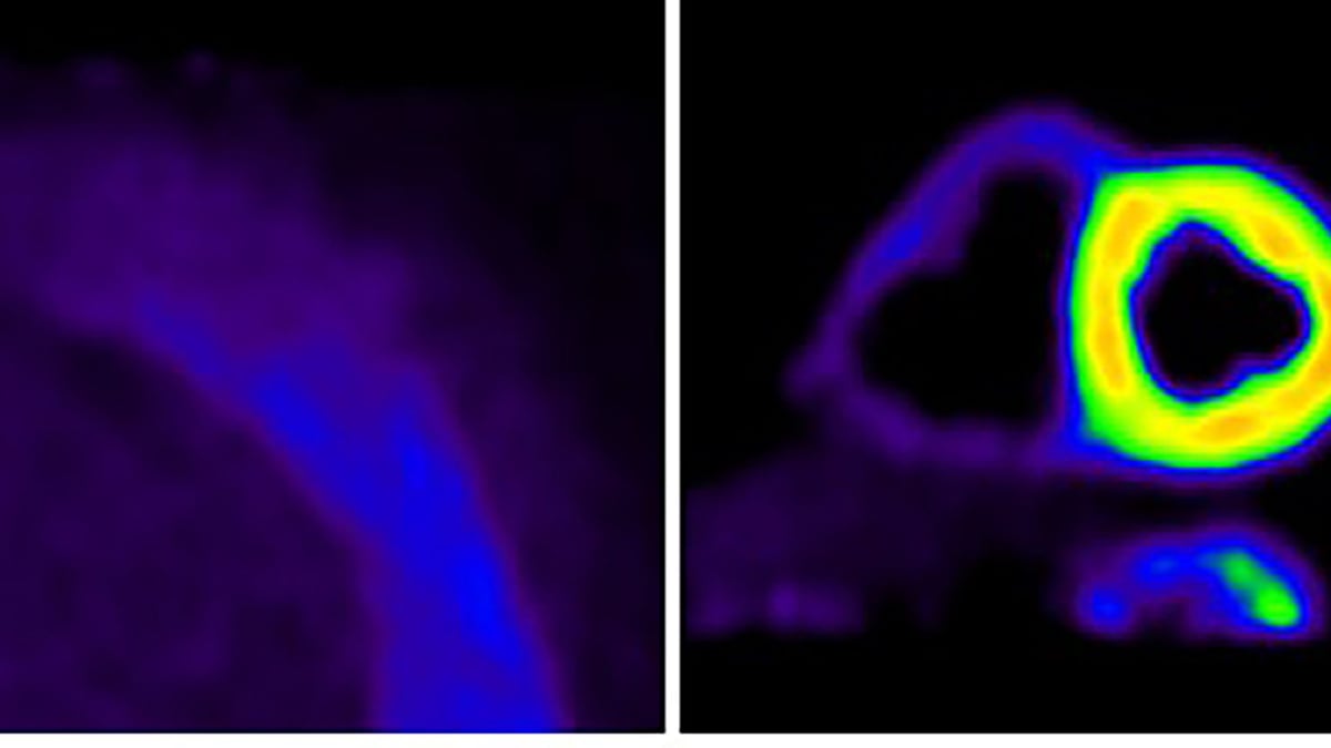 PET-bilden visar skillnaden mellan ett friskt hjärta (vänster) och ett hjärta med amyloidosaggregat/inlagring (höger). Foto: Akademiska sjukhuset