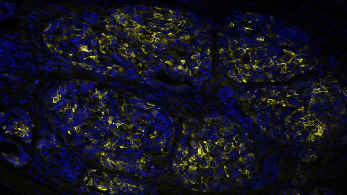 Insulinproducerande celler framodlade ur stamceller, experimentellt transplanterade till en muskel. Insulin ses i gult och cellkärnor i blått.