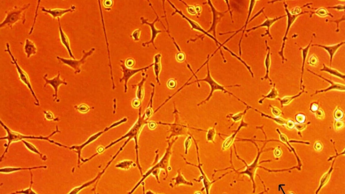Hjärnceller hos en MS-sjuk person odlade i laboratorium.
