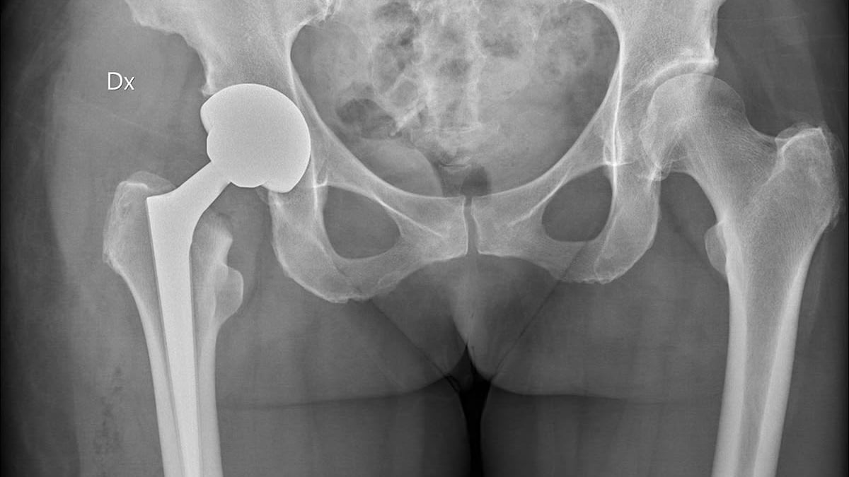 Röntgenbilden visar ett bäcken där patienten på ena sidan (vänster i bild) fått en höftprotes inopererad.
