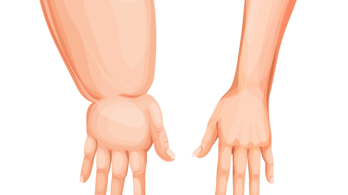 Lymfödem innebär att lymfvätska ansamlas i vävnaden på grund av ett skadat lymfsystem. Vanligast är lymfödem i en arm eller ben efter cancerbehandling eller annat trauma. Vid komplexa lymfödem kan flera organ beröras och patienten behöva träffa flera specialister för att snabbt få rätt vård. Därför har Akademiska startat multidisciplinära ronder. Bild: Mostphotos