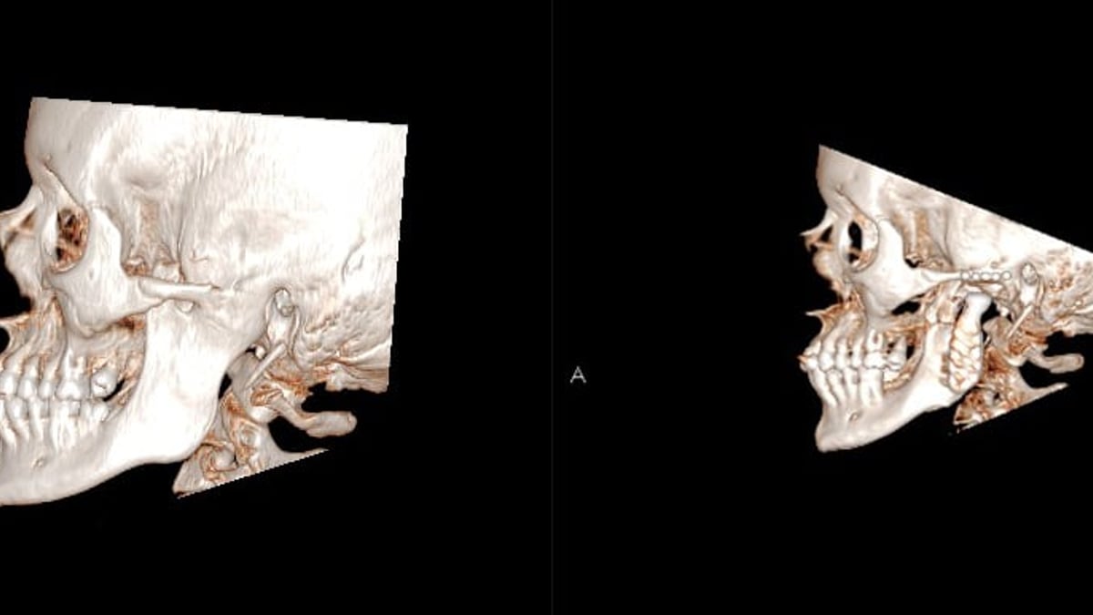 Tack vare en käkledsprotes har en patients gapförmåga ökat från 0 till 30 mm. Bilderna är tagna med datortomografi (DT), den till höger togs 4 år efter operationen. Eftersom materialet polyeten inte är röntgenkontrasterande syns inte ledpannan. I underkäken syns så kallade metallartefakter (effekter av mindre störningar från metall) utanpå delen som sitter på underkäken.