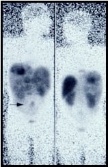  Somatostatin receptor scintigraphy (SRS)
