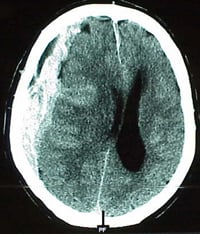 Datortomografibild på hjärnan.