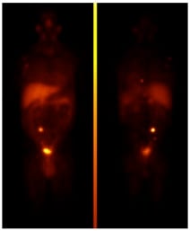 Metaiodobenzylguanidine (MIBG)
