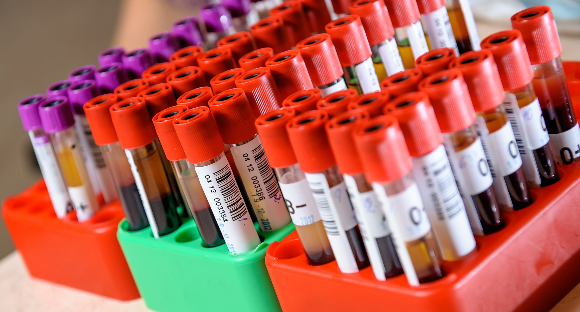 Forskare på Akademiska sjukhuset har i en studie funnit att två biomarkörer i blodet är vanligare hos svårt sjuka covidpatienter som utvecklar muskelsvaghet under intensivvård. Detta kan leda till att förebyggande behandling kan sättas in tidigare.