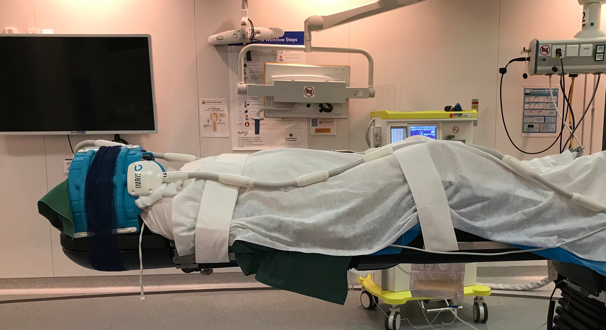 Djup hjärnstimulering (DBS) är en kompletterande behandling vid bland annat Parkinsons sjukdom. Akademiska sjukhuset är först i Norden med en ny DBS-modell som innebär att man med avancerade elektroder kan läsa av signaler från hjärnan samtidigt som patienten får behandling.