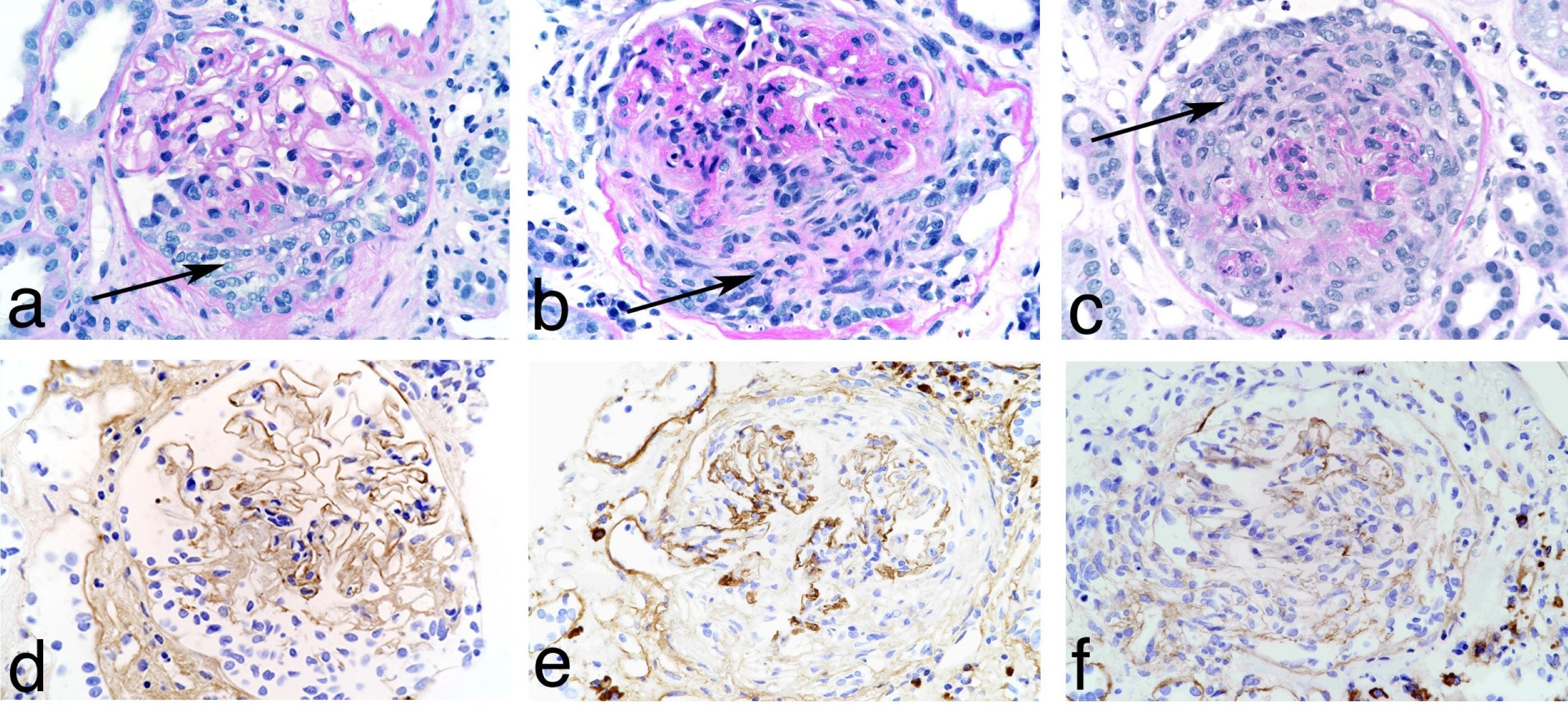 Mikroskopbild av sjuk njurvävnad (glomeruli). Njurbiopsi är en invasiv undersökning som fortfarande ses som nödvändig. Forskare engagerade i den nationella njurmedicinska biobanken hyser dock förhoppningen att det i framtiden ska räcka med att använda en biomarkör från blod- eller urinprov för att ställa diagnos och styra behandlingen vid njursjukdomar.