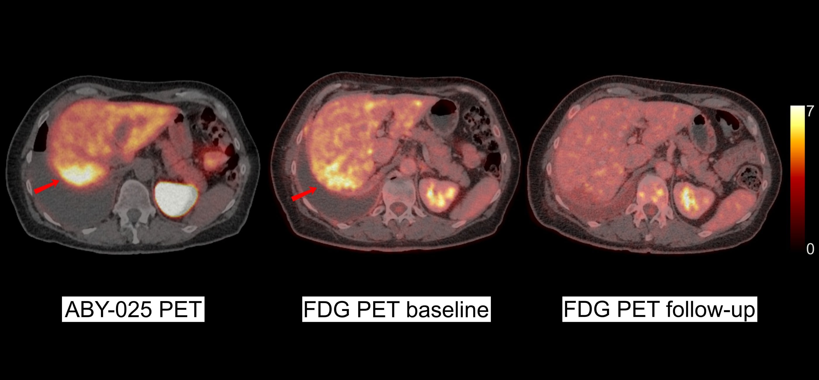 HER2-positiv bröstcancer är mycket aggressiv och tidig upptäckt av stor vikt. En studie vid Akademiska sjukhuset visar att en ny metod för diagnostik ger snabbare och säkrare svar än traditionell biopsi. Metoden innebär att patienten får en liten dos med små proteiner, så kallade affibodymolekyler, laddade med radioaktiva ämnen. Via PET-, eller SPECT-kameror fångas radioaktiviteten upp. I en studie på Affibody PET kunde man förutsäga hur patienten skulle svara på behandling vid spridd bröstcancer  (Foto: Akademiska sjukhuset)