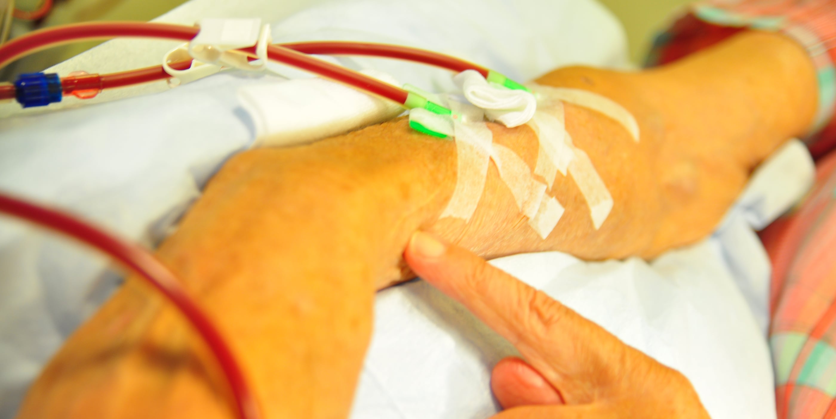 Vissa personer med avancerad kronisk njursvikt har behov av dialys eller njurtransplantation. I en ny studie vid bland annat Akademiska sjukhuset ska man utvärdera om/när patienter med avancerad njursvikt och förmaksflimmer ska rekommenderas behandling med blodförtunnande läkemedel. Idag saknas tillräcklig kunskap om detta. Fotograf: Christian Farman