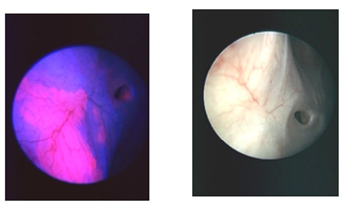 Med en fotodynamisk metod kan urinblåscancer upptäckas och behandlas effektivare på Akademiska. Cancercellerna återreflekteras i rött (vänster).