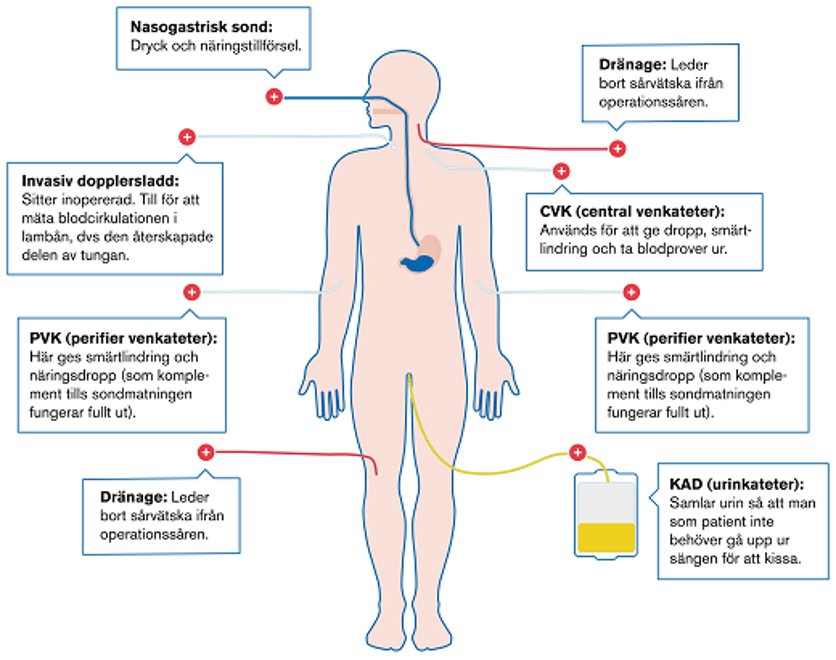 Diagram över slangar kopplade till kroppen efter operation