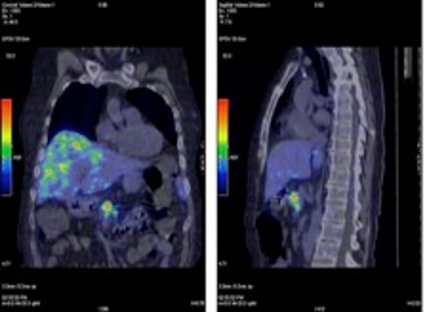 68Ga-DOTA-octreotate-PET