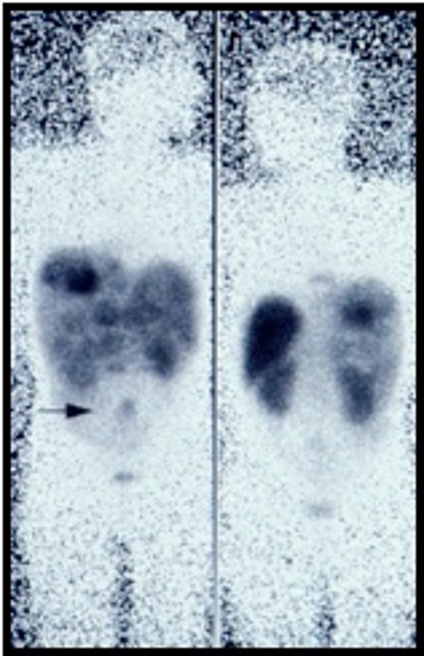  Somatostatin receptor scintigraphy (SRS)