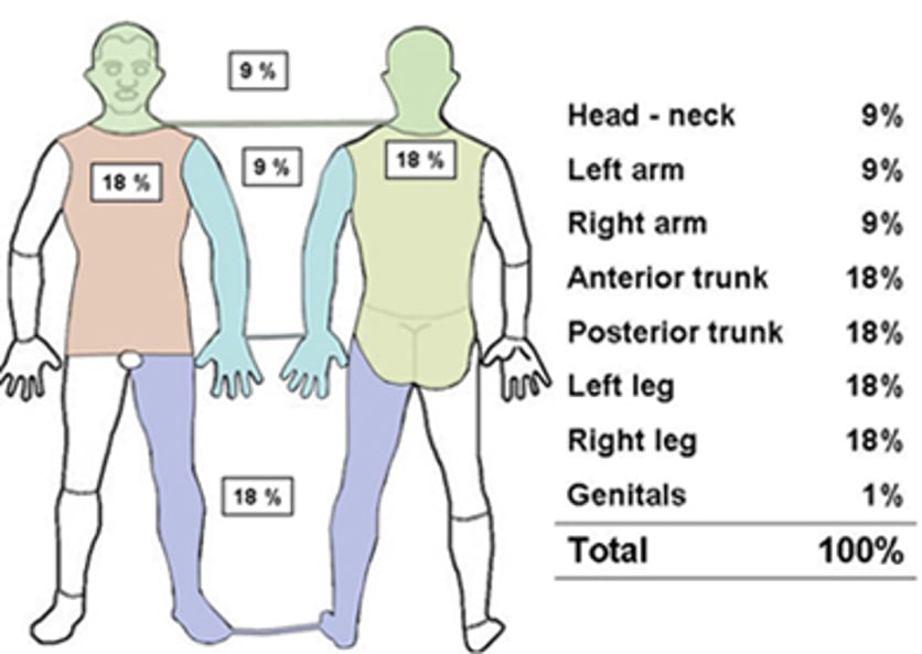 diagram utbredning av brännskada på kroppen