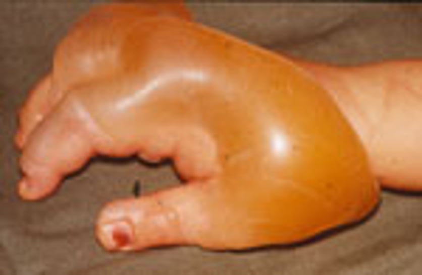 ytlig andra gradens brännskada