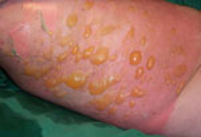 utlig delhudsbrännskada