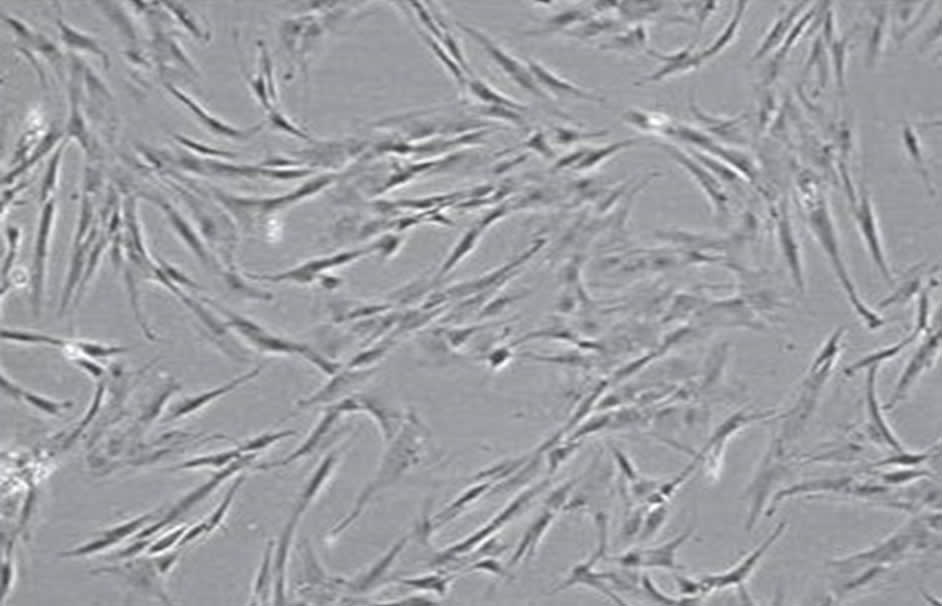 I en ny nordisk studie, ledd från Akademiska sjukhuset, ska patienter med akut livshotande transplantat-mot-värd reaktion, så kallad GVHD, behandlas med moderkaksceller för att stoppa avstötningsreaktionen.