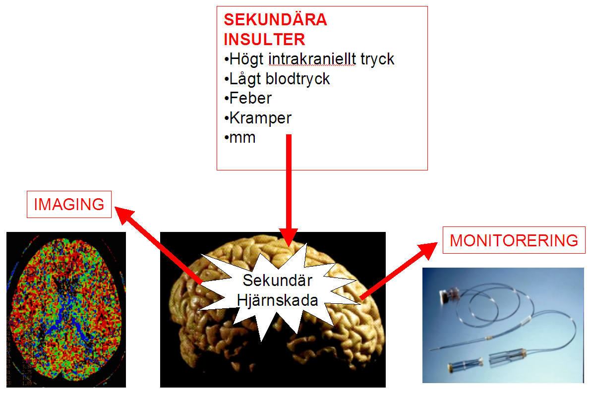 Bild som visar sekundär hjärnskada och behandlingseffekter.