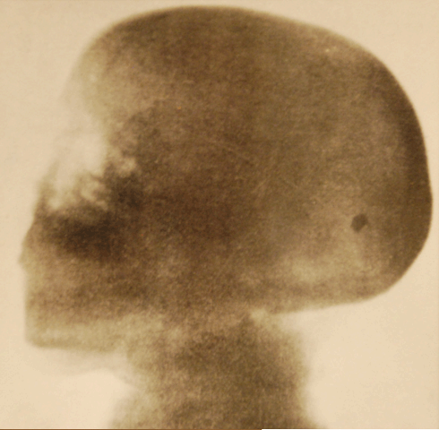 Röntgenbild av skeletthuvud.