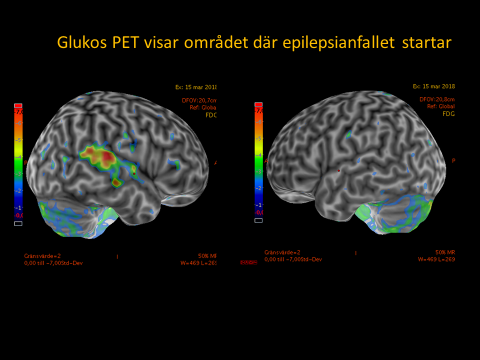 Bilden föreställer en PET-undersökning med  fluoro-deoxy-glukos som visar en epileptisk förändring 