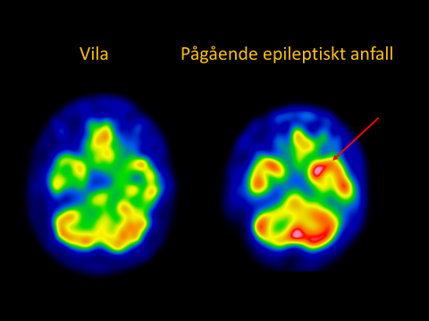Blodflödesmätning under ett pågående epileptisk anfall i spetsen av vänster tinninglob.