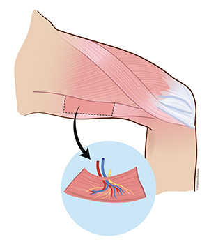 Illustration över lårmuskel
