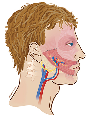 Illustration på ansikte med muskel från låret som kopplas ihop med nerven till tuggmuskeln.