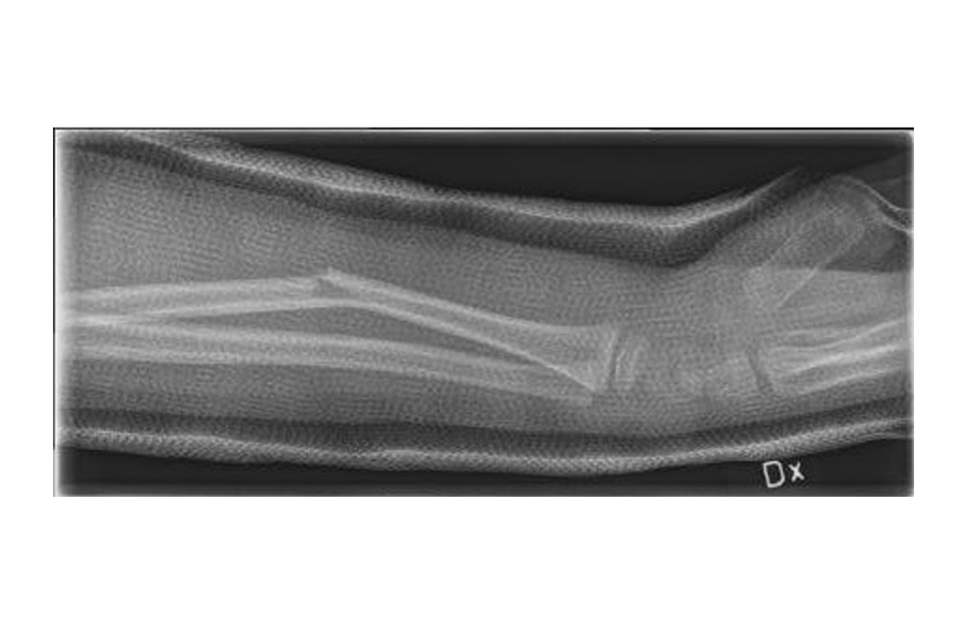 Röntgenbild på en arm.