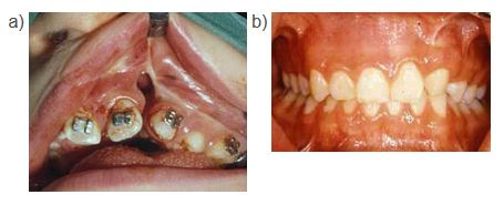 Operation med bentransplantation